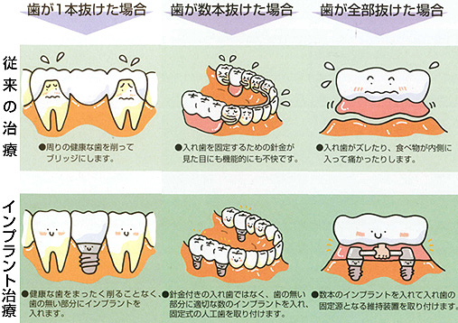 従来の治療とインプラント治療の比較/広島市 歯医者 歯科