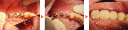 （症状）　右上の奥歯が3本無く、入れ歯を入れておられた方/広島市 歯医者 歯科