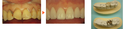 セラミックの詰め物施術前後写真と比較/広島市 歯医者 歯科